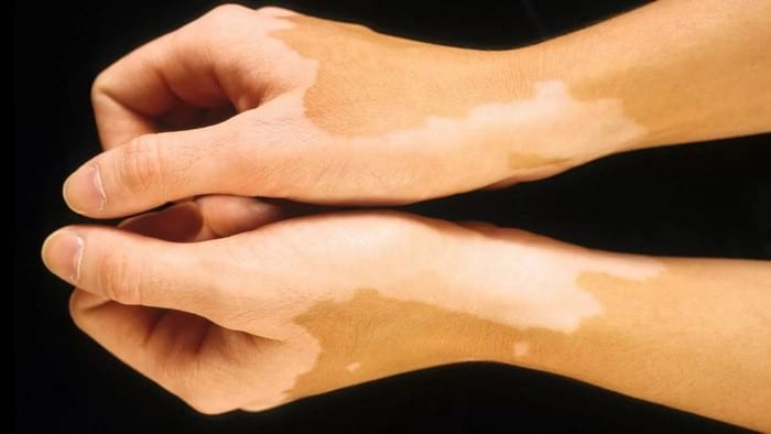 Белые пятна на коже: причины возникновения и методы лечения
