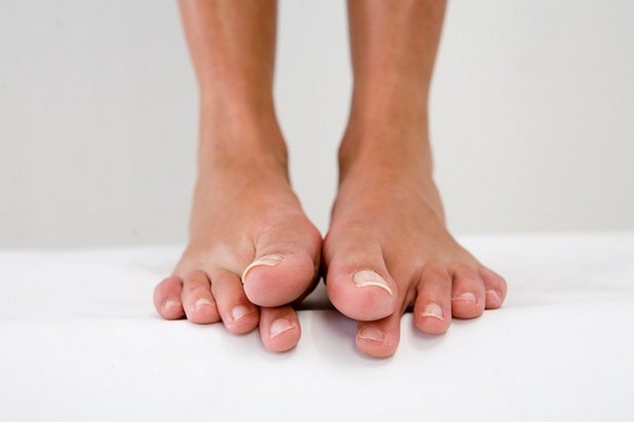 Как лечить вросший ноготь на большом пальце ноги в домашних условиях
