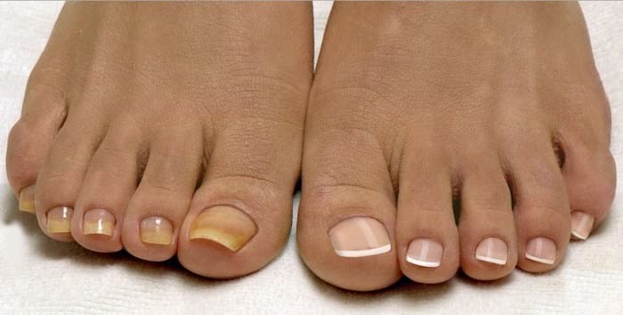 Лечение грибка ногтей современными и народными способами