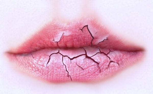 Почему трескаются губы: причины и лечение