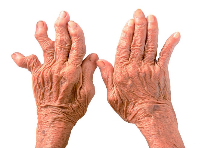 Причины и способы лечения артрита пальцев рук