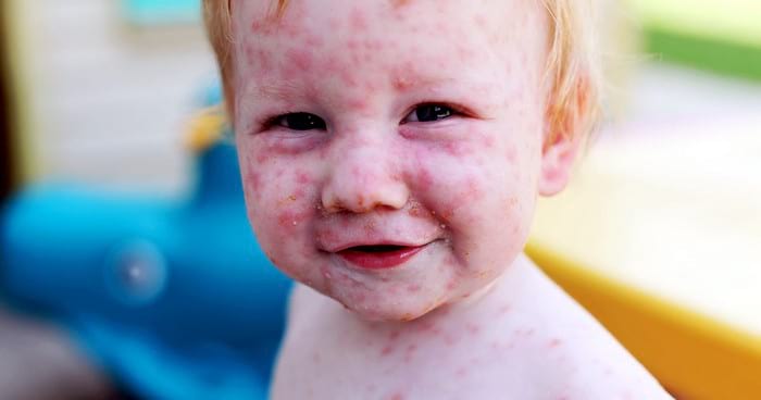 Симптомы краснухи у детей: первые признаки и способы лечения