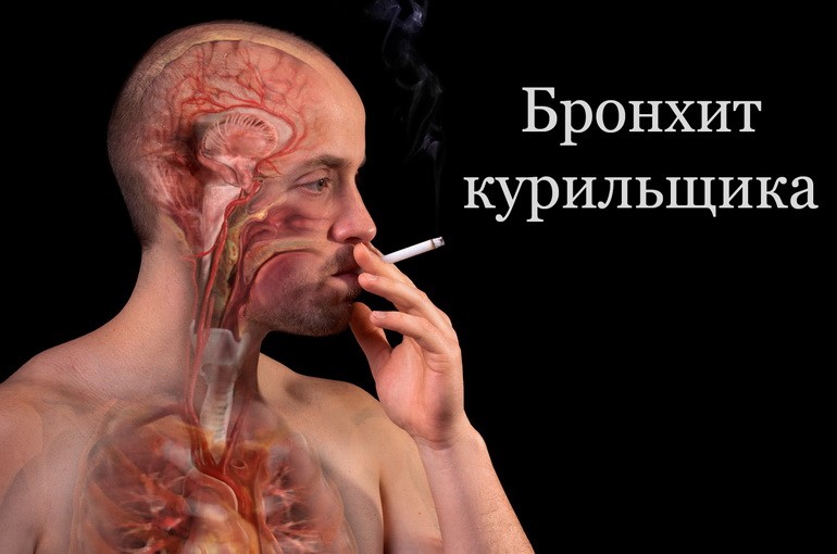 Бронхит курильщика: симптомы и лечение, осложнения