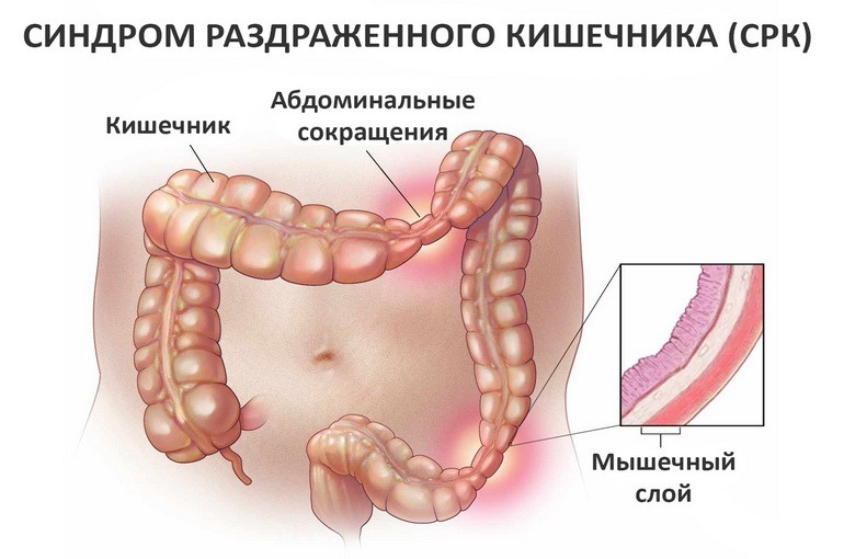 Синдром раздраженного кишечника (СРК): симптомы и лечение