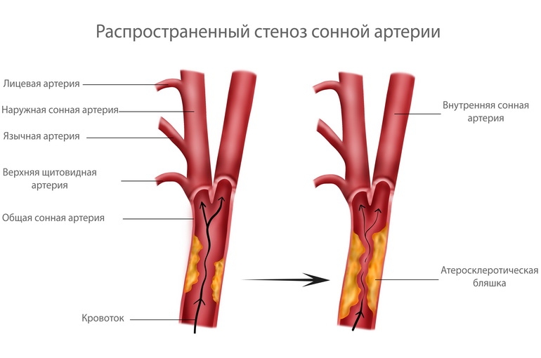 Атеросклероз брахиоцефальных артерий: симптомы, лечение, факторы риска