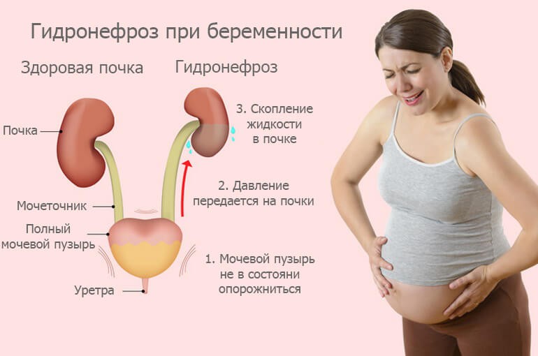 Гидронефроз при беременности: причины, симптомы, лечение, риски